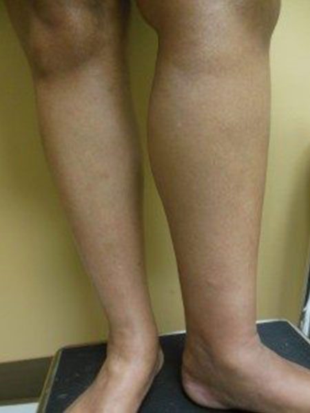 Leg Swelling Tampa Leg Pain Tampa