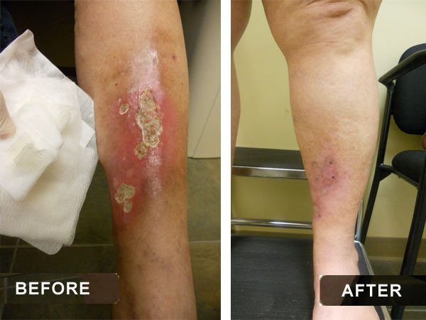 vein disease treatment before and after