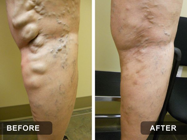 vein treatment before and after