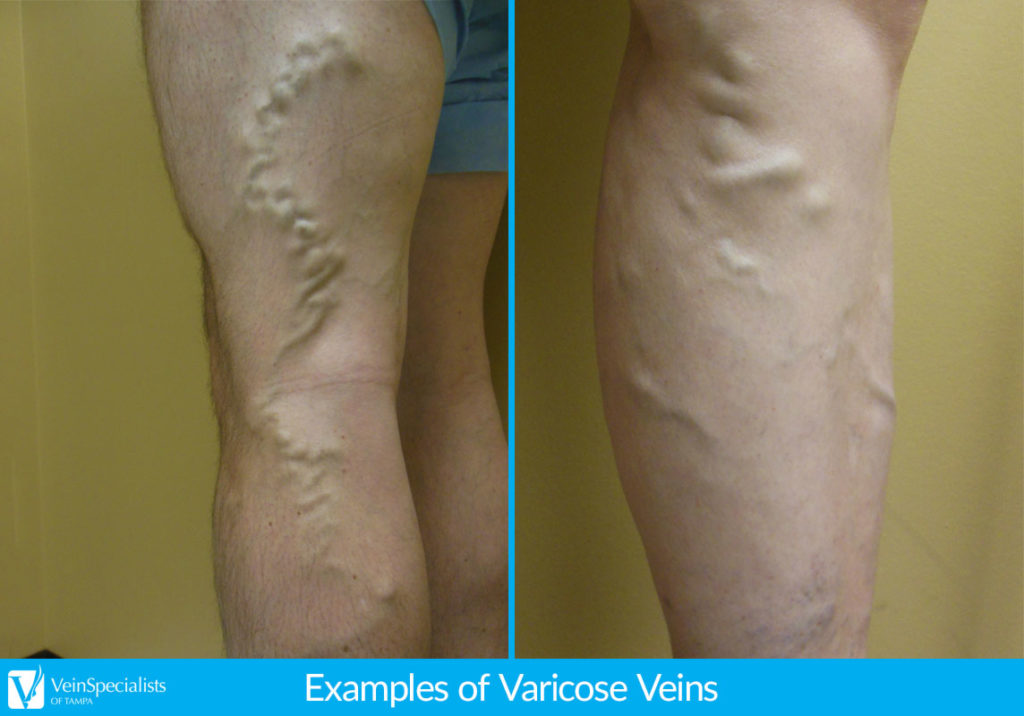 Causes of Varicose Veins Tampa FL Vein Care Specialists