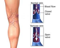 bleeding varicose veins